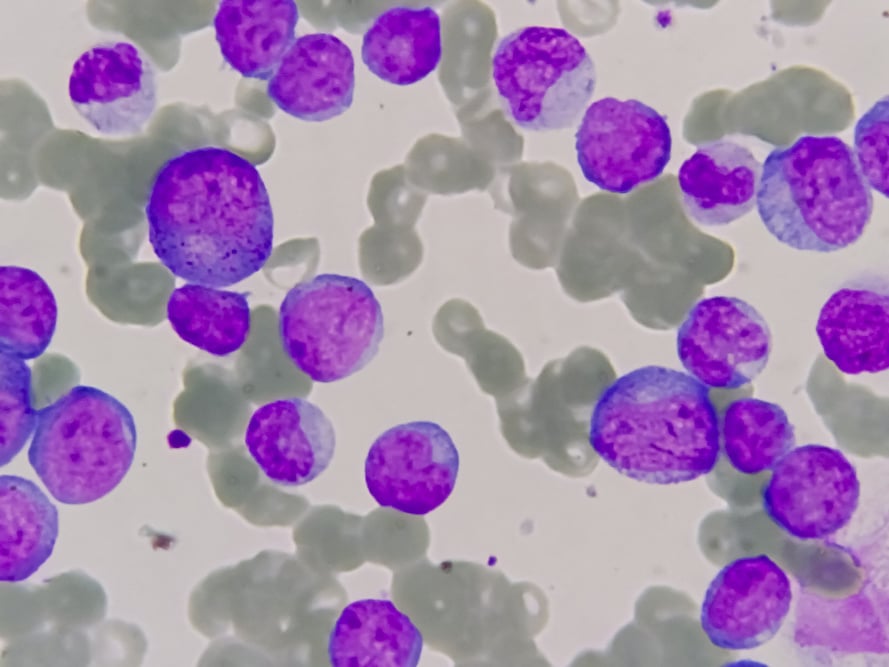 Microscopic leukemia cells