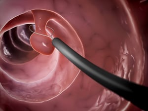 ¿Qué son los pólipos de colon y son cancerosos?