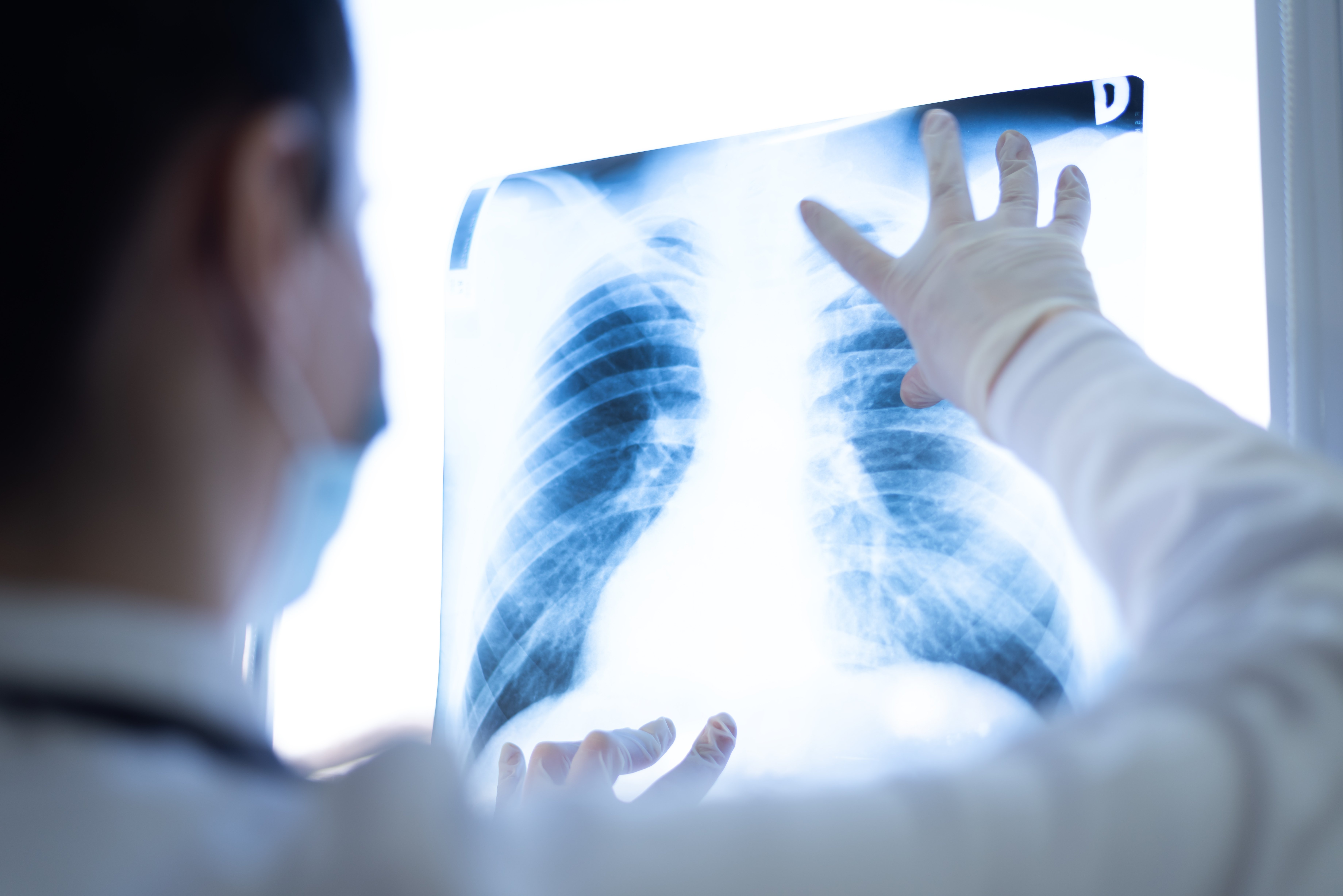 A doctor looking at a chest xray.